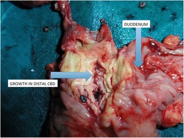 Postoperative specimen with arrows pointing towards duodenum and growth in the intrapancreatic portion of the CBD