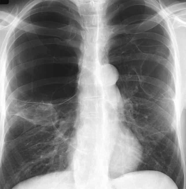 Image of 'vanishing lung'