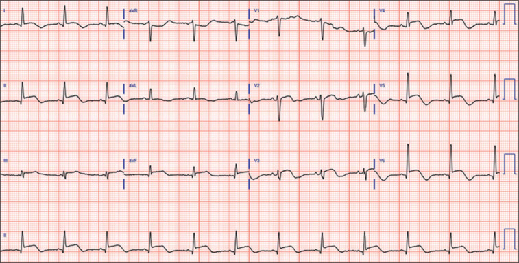Electrocardiogram at day 3 of admission