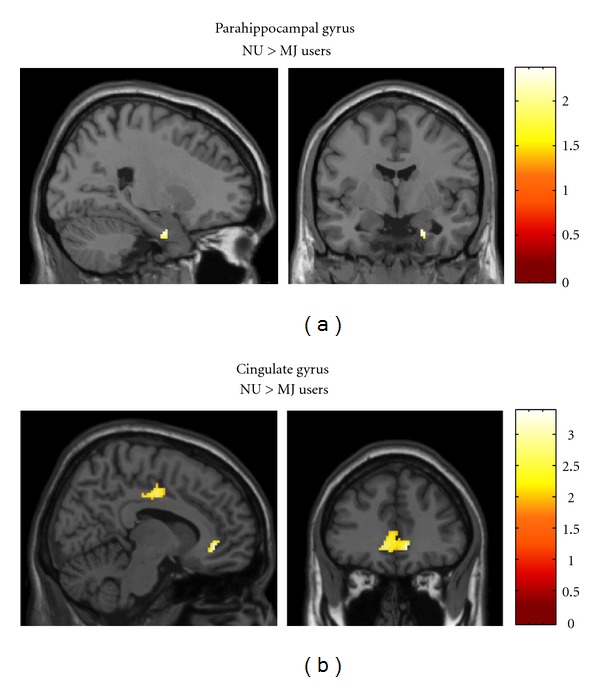 Representative SPM images depicting significant activation for the Retrieval-Motor Control contrast for NU > MJ contrast. (a) NU displayed greater activation in the right parahippocampal gyrus relative to the MJ group. (b) NU displayed greater activation in the bilateral anterior cingulate gyrus and bilateral midcingulate gyrus relative to the MJ group. For the MJ > NU contrast, the MJ group showed no regions of greater BOLD activation relative to NU group. All images are in neurological orientation, that is, left = left and right = right; the color bar at the right reflects the suprathreshold value of the SPM (t) statistic for the analysis.