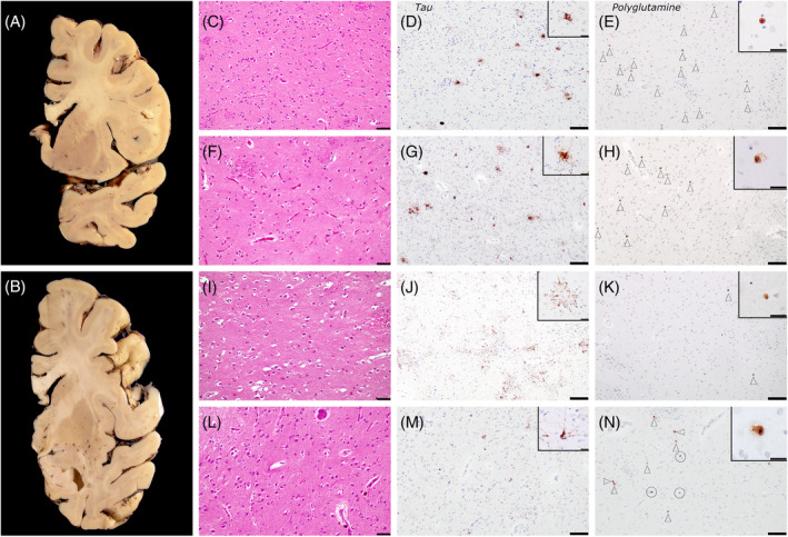 Neuropathological analysis of CAG HTT pathological expansion carriers A and B coronal sections of patient BK1291. Her brain weighed 1,105 grams, and macroscopic evaluation highlighted a mild to moderate temporoparietal cortical atrophy with ventricular dilation. The basal ganglia, including head of the caudate, were relatively spared, with minimal atrophy. Head of the caudate of patient BK393 in C to E, BK311 in F to H, BK1291 in I to K and BK654 in L to N. Hematoxylin and eosin showed moderate gliosis, with mild atrophy and neuronal loss in patient BK393 (C). There was mild parenchymal arteriosclerosis with mild perivascular rarefaction. Patient BK311 had mild gliosis without discernible atrophy or neuronal loss (F). In BK1291 (I) the head of the caudate and the rostral putamen nucleus showed mild atrophy, with mild neuronal loss and mild to moderate gliosis. They had mild arteriosclerosis with occasional perivascular hemosiderin deposits. BK654 (L) had a moderate parenchymal arteriosclerosis and arteriolohyalinosis, with perivascular rarefaction and hemosiderin deposits. The striatum showed mild to moderate gliosis (more intense in putamen), with minimal atrophy and neuronal loss. Staining against hyperphosphorylated Tau revealed moderate involvement of the caudate nucleus in patients with PSP (patients BK393 (D) and BK311 (G), insets tufted astrocytes), and in the patient with CBD (BK1291, inset astrocytic plaque). In patient BK645, with AD, Tau showed isolated neurofibrillary tangles and pretangles (M, inset neuronal pretangle). Polyglutamine positive neurons were detected in the caudate of all four patients (E, H, K, N, insets neuronal intranuclear polyglutamine inclusions), in variable densities (white arrowheads). Of note, BK1291 had comparatively more inclusions in parahippocampal cortex (not shown) compared to the head of the caudate (K), while in BK654 they could be confounded with moderate hemosiderin deposits (N, white circles). Scale bars: C, F, I, L 50 μm; D‐E, G‐H, J‐K‐M‐N 100 μm; Insets 20 μm.