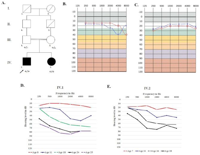 Pedigree information and hearing level in family. (A) Pedigree of the family indicates a pattern autosomal recessive inheritance. The pedigree shows co-segregation of ABHD12 variant ((+) = NM_001042472.3:c.601dup; p.(Val201GlyfsTer4). In this image, the arrow presents proband, black symbols implicate affected; white symbols represent unaffected; circles are females; squares are men; and parallel lines indicate consanguineous marriage. (B) Pure tone audiograms of an unaffected father. (C) Pure tone audiograms of an unaffected mother (D) Audioprofile indicates progressive hearing loss in patient IV.1 in 8-year, 11-year, 18-year, 24-year and 25-year, respectively. (E) Audioprofile indicates progressive hearing loss in patient IV.2 in 7-year, 11-year, 16-year and 18-year, respectively. The frequency is shown in hertz (Hz) and the hearing threshold is shown in decibels (dB). The blue ‘×’ and red ‘o’ show results from an air conduction test of the left and right ear, respectively