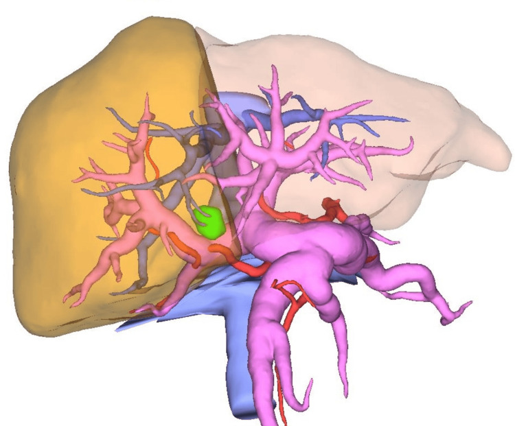 Preoperative simulation imagesPreoperative three-dimensional simulation using SYNAPCE VINCENT® visualizing the spatial relationship between the tumor, and adjacent vascular structures. This simulation facilitated precise assessment of tumor extent, determination of the hepatic transection line, and formulation of an optimal operative strategy.