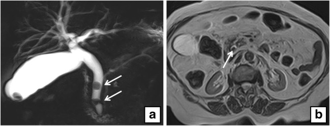 a Coronal maximum intensity projection (MIP) reformat shows two filling defects in a dilated CBD (arrows) and one in the gallbladder. b Axial T2-weighted MRI of the same patient shows a filling defect in a dilated CBD (arrow)