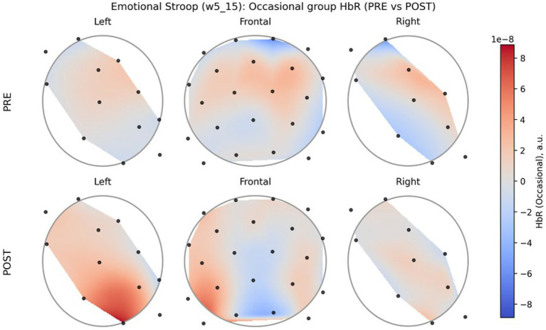 Topographic brain maps compare pre- and post-task deoxyhemoglobin (HbR) activity during an emotional Stroop task in occasional users, with left, frontal, and right regions shown for each phase. Warmer colors indicate increased HbR, cooler colors show decreased values, with a vertical color bar showing the scale. Black dots represent measurement channels.