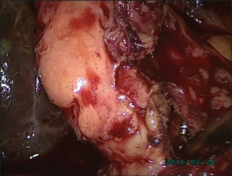 Choledochotomy has been done. Tip of basket being seen inside the CBD through the choledochotomy incision