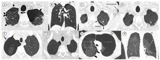 Axial and coronal unenhanced thin-slice chest HRCT scans (A and B, respectively) in a 25-year-old male cannabis smoker, showing a large (5 cm) bulla (white arrows), sharply demarcated by a thin wall in the left lung apex, together with multiple small blebs adjacent to the pleura and small areas of paraseptal and centrilobular emphysema in both lung apices (black arrows). Axial unenhanced thin-slice chest HRCT scans (C and D, respectively) in a 45-year-old male cannabis smoker, showing left pneumothorax (arrows in C) with marked bilateral apical subcutaneous emphysema and sparse areas of paraseptal emphysema along with small blebs and rare bullae that resolved after drainage. Axial unenhanced thin-slice chest HRCT scans (E and F, respectively) in a 23-year-old male cannabis smoker, showing extensive pneumothorax on the right side (black arrow in E) with some blebs adjacent to the visceral anterior pleura and small areas of paraseptal emphysema on the same side, with complete resorption of pneumothorax after chest drainage. Axial unenhanced thin-slice chest HRCT scan (G) in a 32-year-old male cannabis smoker, showing extensive alterations due to destruction of lung tissue on both sides with a coarse bullous formation on the left (white arrow). Coronal multiplanar reconstruction (H) of the same patient showing the bullous formation occupying the upper and middle thirds of the left hemithorax, with subtle septation. In the right lung (visible in G), there were marked changes from paraseptal and centrilobular emphysematous damage (black arrows and square outline, respectively).