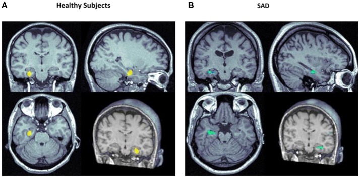 Focus of significantly increased (yellow) and decreased (blue) rCBF in the left hippocampal area in healthy subjects (A) (57) and subjects with social anxiety disorder (SAD; B) (59) following the administration of CBD vs. placebo.