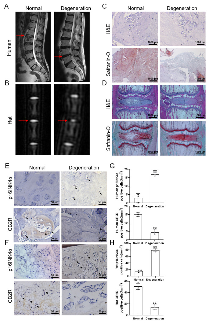 Low expression of CB2R in degenerated IVD tissue. (A) T2-weighted MRI scans of human IVD (red arrows indicate the corresponding IVD); (B) T2-weighted MRI scans of rat caudal IVD at 1 week after operation. (red arrow indicate the corresponding IVD); (C) H&E and safranin-O staining of human NP tissues (scale bar = 1000 μm); (D) H&E and safranin-O staining of rat NP tissues (scale bar = 1000 μm). (E-F) Immunohistochemical staining results of CB2R and p16INK4a in human and rat NP tissues (scale bar = 50 μm, black arrows indicate positive cells); (G-H) Quantification of CB2R and p16INK4a expression in the NP tissues of human and rat. Each experiment was conducted thrice. **p < 0.01 vs. the normal group.