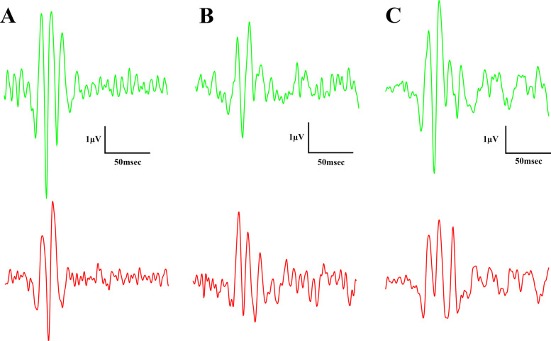 Light-adapted oscillatory potential (OP) waveforms elicited by flash light strengths (from the bottom to the top) 3000 and 10000 mcd·s/m2. A Lean group; B ZDF group; C ZDF + CBD group