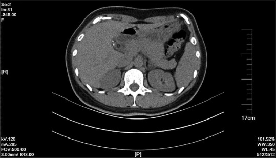 The Hem-o-lok clip near the T-sinus