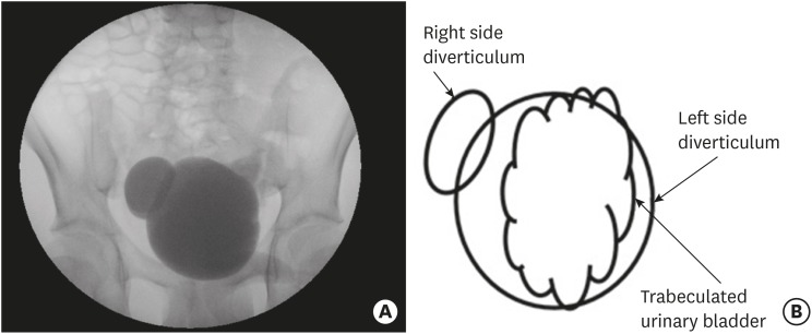 Bilateral bladder diverticula without vesicoureteral reflux. (A) Voiding cystourethrogram and (B) diagram.