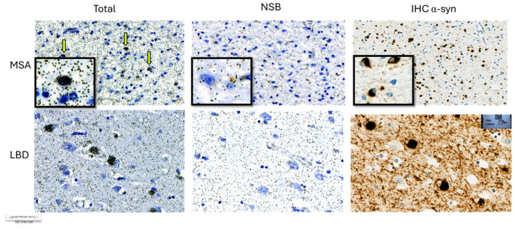 Representative high magnification images from immunohistochemistry (IHC) and emulsion autoradiography (ARG) with 25 nM [3H]GMC-058 performed on TMA sections from cases with MSA and Lewy-body disease. ARG signal (silver grains on the left) correspond to α-syn inclusions in MSA (oligodendrocytic cytoplasmic inclusions) and PD (Lewy bodies) and is reduced after co-incubation of 5 µM GMC-044.