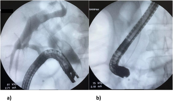 (a) Extractor balloon used to perform the shortening manoeuvre. (b) Duodenoscope position after shortening manoeuvre