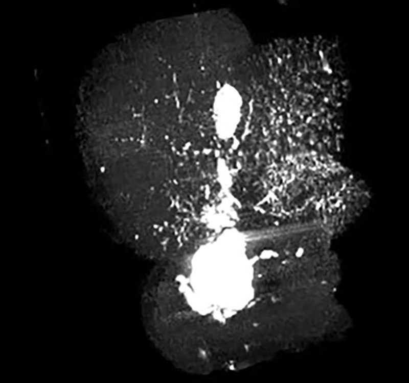 Experimental mouse at 12 weeks of age demonstrates fusiform extrahepatic bile duct dilation (green arrowhead) on CT cholangiogram (the gallbladder is denoted by the green arrow)