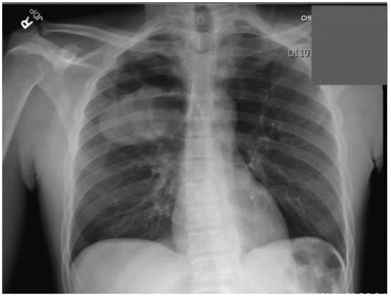 Chest X-ray-large oval mass in right upper lobe may represent bulla or soft tissue mass.
