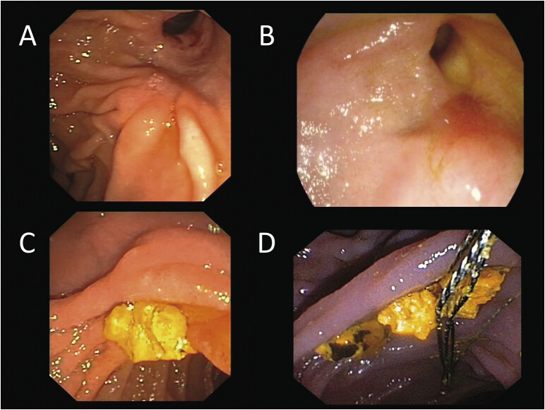 ( A , B ) Wide biliary orifices after previous endoscopic sphincterotomy and removal of biliary stones. ( C , D ) Material removed from the common bile duct. Microscopy showed vegetable fibers.