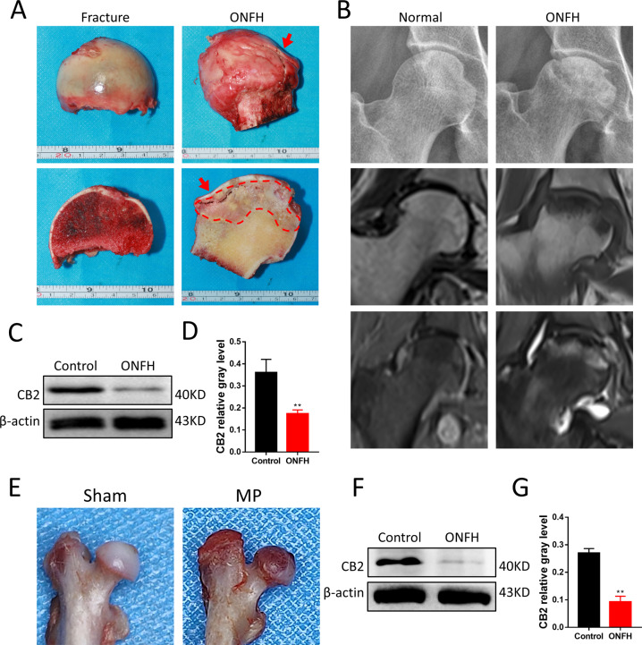 Gross morphology and CB2 expression changes of GC-induced ONFH.A Gross morphology of non-ONFH and GC-induced ONFH femoral head. B X-ray and MRI images of hip joints. C, D Expression of CB2 in human femur tissues, n = 3 per group. E Representative photography of normal and pathological rat femoral heads. F, G Expression of CB2 in rat femoral head, n = 3 per group (n = 3 per group, data are shown as mean ± SD, **p < 0.01).