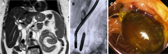 Management of difficult common bile duct stone by endoscopic sphincterotomy and large balloon dilation. A: Magnetic resonance imaging showing a large stone in the distal common bile duct; B: Fluoroscopic appearance of endoscopic papillary large balloon dilation with a pneumatic balloon filled with contrast medium; C: Final endoscopic view of the stone extracted by a Dormia basket.