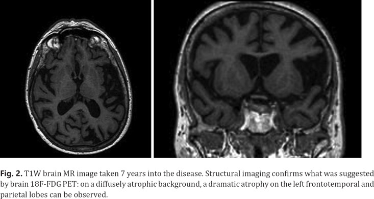 T1W brain MR image taken 7 years into the disease. Structural imaging confirms what was suggested by brain 18F-FDG PET: on a diffusely atrophic background, a dramatic atrophy on the left frontotemporal and parietal lobes can be observed.