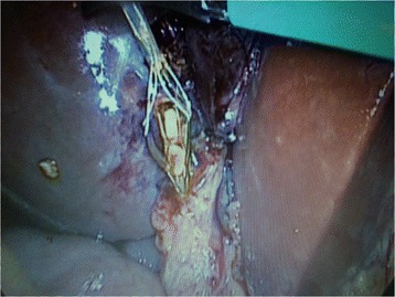 Trans-cystic stone extraction by Dormia basket