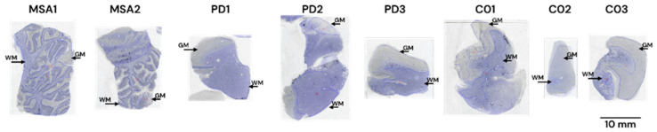 Representative ROIs selected in tissue sections from patients with multiple-system atrophy (MSA), Parkinson’s disease (PD), Lewy-body disease (LBD), and controls (CO) on which analysis was done for Figure 3 and Table A7. The images illustrate an overlay of the toluidine blue stain with the autoradiogram image from the analysis software, where the ROI delineation is visible. The ROIs delineated on the white matter (WM) and gray matter (GM) are indicated with an arrow. Line scale: 10 mm.