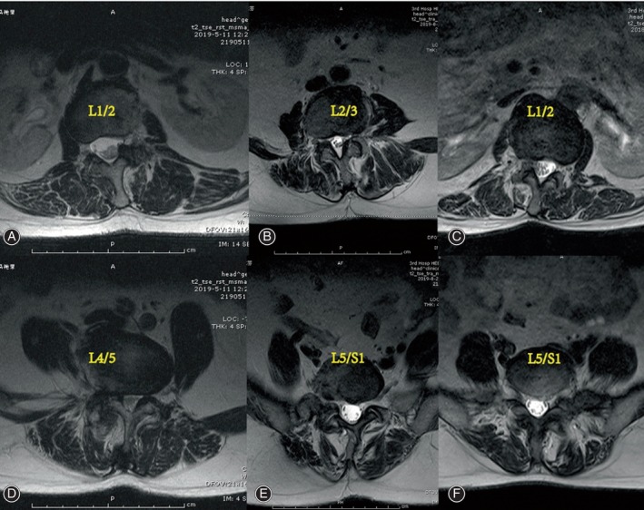 MRI showing the apex of the primary curve and fractional curve of the three sub‐types. Type A (A, D) shows L1/2, L4/5. Type B (B, E) shows L2/3, L5/S1. Type C (C, F) shows L1/2, L5/S1.