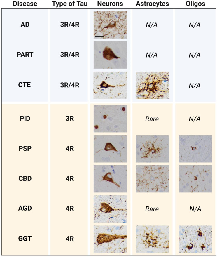 Tau pathology across diseases. Tau pathology is found exclusively in neurons in AD and PART, which are mixed 3R/4R tauopathies. In 4R tauopathies, such as PSP, CBD, and GGT, tau pathology is seen in neurons, astrocytes, and oligodendrocytes. Both PiD, a 3R tauopathy, and AGD, a 4R tauopathy, show primarily neuronal pathology with rare astrocytic involvement. Although neuronal inclusions in CTE are composed of both 3R and 4R tau, the astrocytic pathology is predominantly 4R. Scale bar = 20 μm