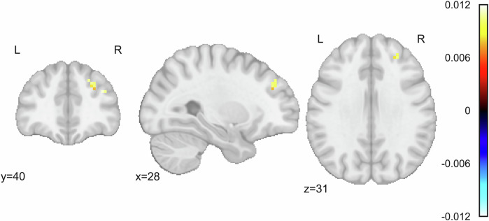 Change in clinician assessed PTSD symptoms between baseline and endpoint is significantly associated with activation in the right dlPFC during the emotional conflict task.Color bars depict standardized β values for the main effect of ΔCAPS in a linear mixed effects model defined as ΔCAPS + Previous Trial*Current Trial + Sex + Motion + (1|Subject) + (1|Subject:Previous Trial) + (1|Subject:Current Trial) using AFNI’s 3dLMEr. Significant cluster size was determined using a voxelwise threshold of p = 0.002 and cluster forming threshold of α = 0.05, corresponding to a cluster size of 13 voxels. ΔCAPS was defined as endpoint CAPS – baseline CAPS.