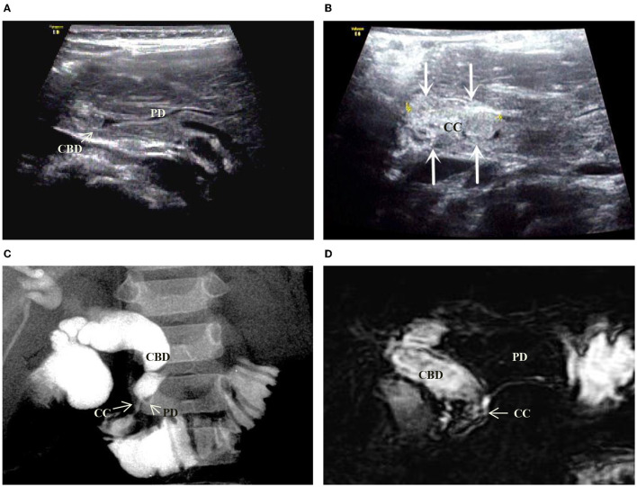 Images of a representative type B of PBM. (A) US transverse scan showed the PD (longitudinal section) joining the CBD which contains the protein plugs. (B) US oblique scan showed the common channel (between the arrows) is dilated and filled with protein plugs. (C) IOC indicated the PD and the dilated CBD joining at a right angle to form a common channel which inserts into the duodenum. (D) MRCP indicated the same features of PD and CBD as that in US and IOC. No significant narrowness in the distal CBD.