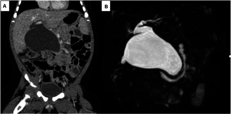 Computerized tomography ( A ) and magnetic resonance cholangiopancreatography ( B ) showed congenital biliary dilatation (5-cm type Ia [Todani classification]).