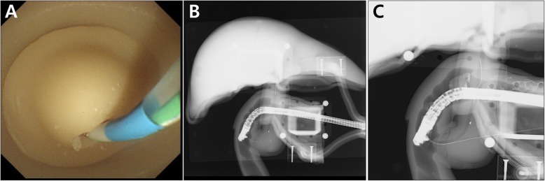 Biliary cannulation using the basic module. a Endoscopic view; b Fluoroscopic view; c Fluoroscopic view of double guidewire technique