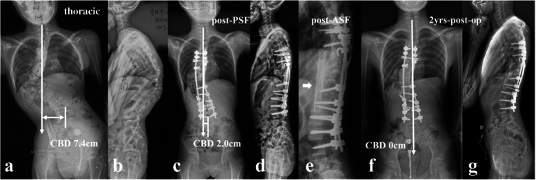 an 11-year-old girl with NF1, suffering from kyphoscoliosis associated with convex trunk shift and dystrophic vertebral rotatory subluxation at T9/10 level (thoracic type) (a, b); Halo Gravity Traction on wheelchair was prescribed for 1 month. Afterwards, stage 1 posterior spinal correction and fusion surgery was performed (c, d), followed by stage 2 supplementary anterior fusion utilizing structural fibular allograft (e, arrow). 2-year-follow up revealed spontaneous improvement of coronal balance with solid fusion (f, g)