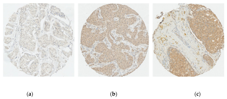 Representative immunostaining of tumour cores for CBR2: Cannabinoid receptor 2 expression intensity scores; (a) 0 (none); (b) 1 (weak cytoplasmic and nuclear staining); (c) 2 (moderate cytoplasmic and nuclear staining). Scale: 10X.