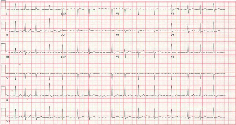 The patient’s electrocardiogram showing atrial fibrillation.