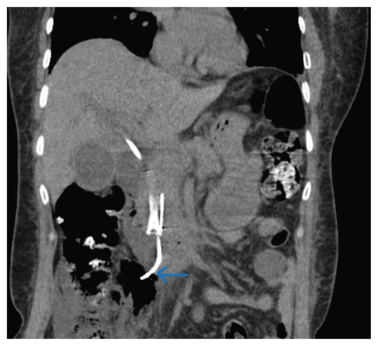 Coronal section of CT abdomen that shows plastic stent perforation into the peritoneum (Blue arrow).