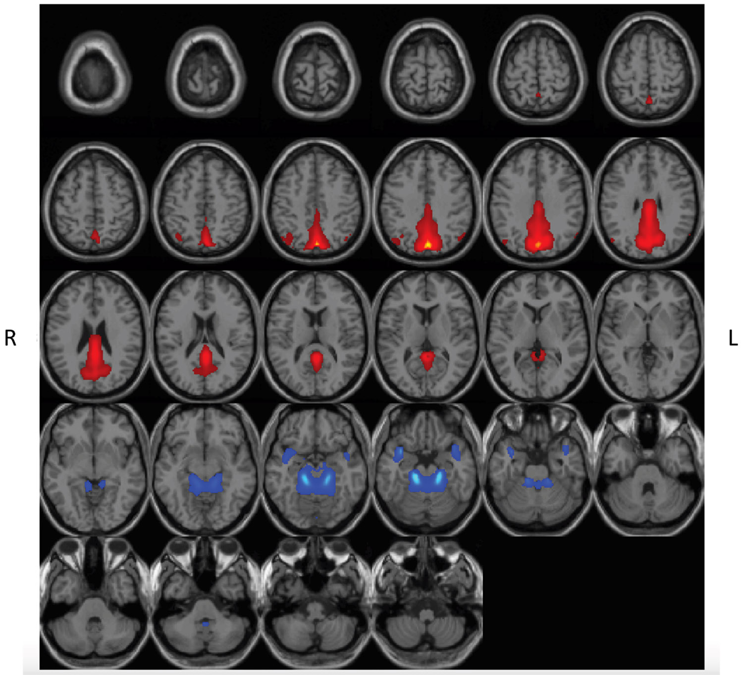 Spatial rendering of brain networks that display greater signal in high- and low-frequency bands during Δ9-tetrahydrocannabinol (THC) intoxication. Spatial rendering of functional networks where THC (vs. placebo) enhanced the presence of high- and low-frequency information (0.05 > Hz > 0.15). Networks included the triple network–default mode (red) and paralimbic (blue) domains. Spatial components are thresholded (t > 2.0). L, left; R, right.