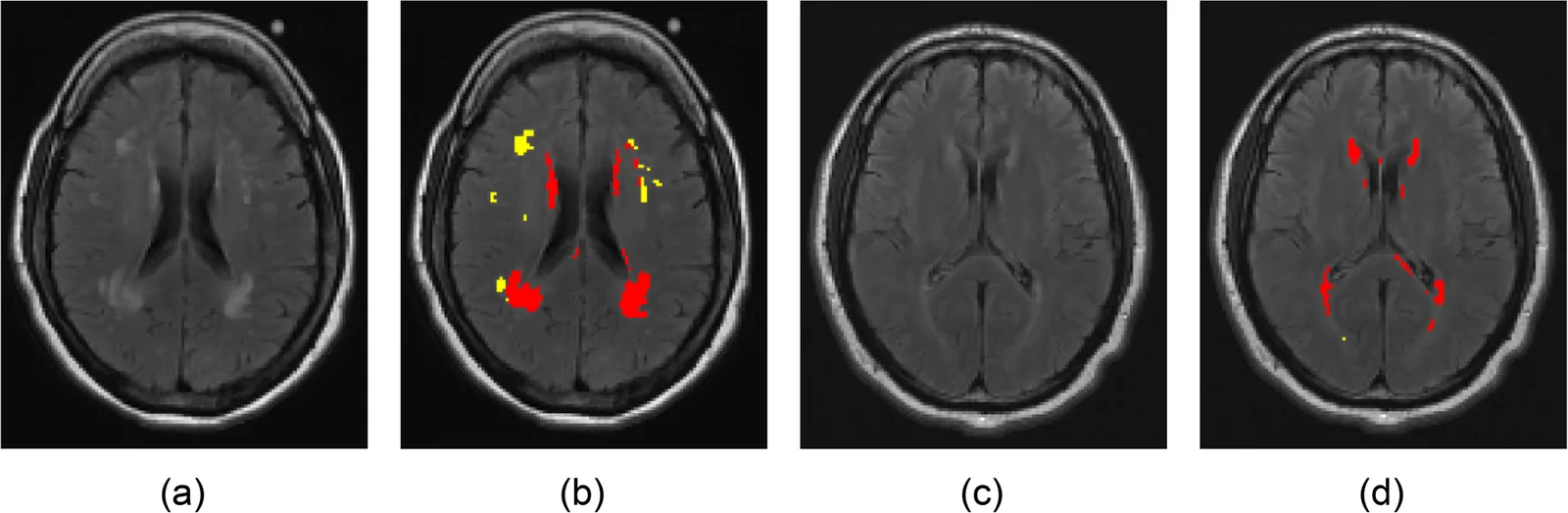 Axial FLAIR images and corresponding segmented WMHs using UBO detector from a representative HIV-only (a, b) and CU-only participant (c, d). pvWMHs and dWMHs are shown in red and yellow colors respectively