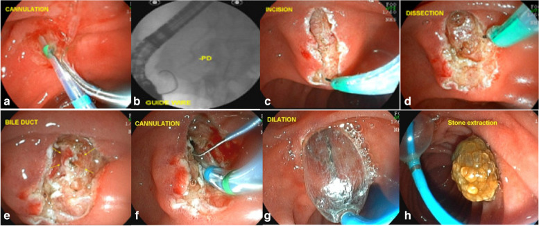 Enlarged fistulotomy of the papilla. a failed cannulation with the sphincterotome and guide wire; b failed cannulation with the guide wire and after injection of a small amount of contrast; c EFP with wide incisions; d dissection of the papilla; e identification of the muscular sphincter of the papilla, the muscular fibers, and the common bile duct mucosa; f easy cannulation of the bile duct after dissection; g dilation with 12 mm balloon of the fistula orifice; h common bile duct stone removal