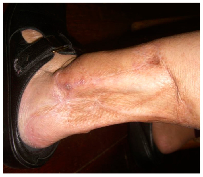 The above patient in Figure 1 with a healed distal left leg wound after debridement, with delayed and primary closures supplemented with split-thickness skin grafts.