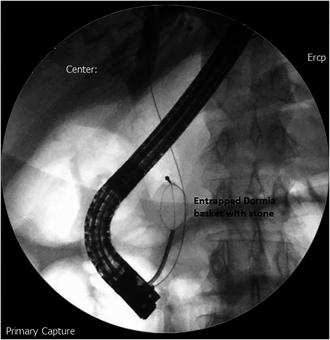 The impacted Dormia basket with a large CBD stone. CBD, common bile duct.
