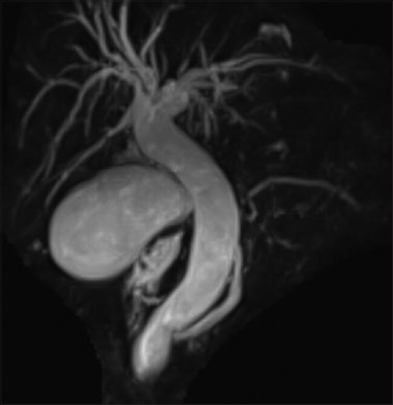 Thick slab image of 52-year-old male of showing upstream dilatation of CBD and dilatation of pancreatic duct in ampullary carcinoma