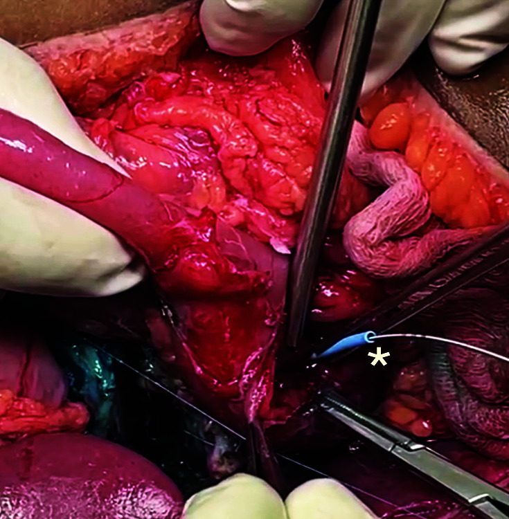 Image depicting the process of securing an endoscopically removal pancreatic stent into the ampulla of duodenum over the guidewire (* = endoscopically removable pancreatic stent over the guidewire in the ampulla)