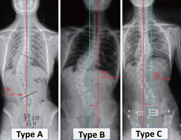 Three preoperative coronal patterns in adolescent idiopathic scoliosis. Type A, coronal balance distance (CBD)<20 mm; type B, CBD≥20 mm and coronal C7 plumbline (C7PL) shifts to the concave side of the curve; type C, CBD≥20 mm and C7PL shifts to the convex side of the curve.