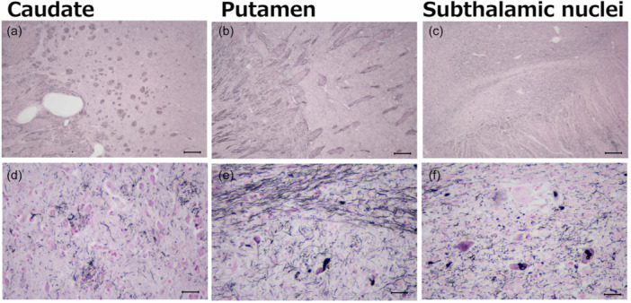 Microscopic findings of the basal ganglia. Numerous threads are visible in the caudate nuclei and internal capsule (a). Astrocytic plaques are seen in the caudate nuclei (d). Abundant neuropil threads are also seen in the globus pallidum and putamen (b). Many threads can be seen in Wilson's pencil fibers (e). The subthalamic nuclei are relatively spared (c) with a fair number of threads and pleomorphic neuronal inclusions. Gallyas‐Braak silver staining (a–f). Scale bars: 500 μm (a–c), 25 μm (d–f).