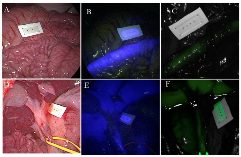 Visualization of the endoluminal small bowel NICE-coated catheter and CBD characterization at 35 min after ICG administration; (A) small bowel RGB image; (B) small bowel NIR-I window, overlay image (RGB + fluorescence); (C) small bowel NIR-II window, overlay (RGB + fluorescence) (D) CBD RGB image; (E) CBD NIR-I window, overlay image (RGB + fluorescence); (F) CBD NIR-II window, overlay (RGB + fluorescence). Abbreviations: RGB—red, green, blue; NIR—near-infrared; NICE—near-infrared coating of equipment, CBD—common bile duct, ICG—indocyanine green.