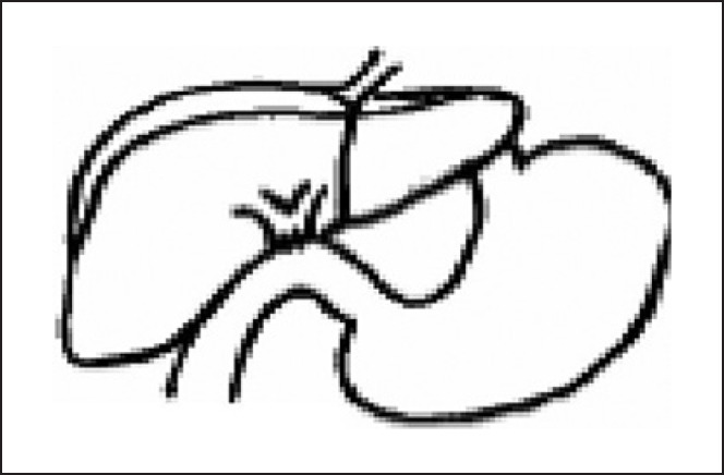 Schematic diagram of HD.