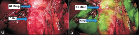 The common bile duct and gall bladder remnant, (a) under normal visualisation and (b) in infrared camera mode with indocyanine green. Upper blue arrow shows Gall Bladder stump and Lower blue arrow shows the Common Bile duct. CBD: Common bile duct, GB: Gall bladder