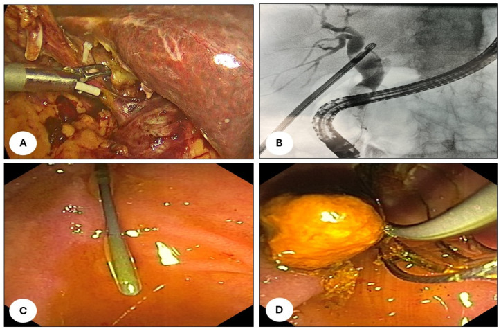 (A) Identification of Calot’s triangle after the division of the cystic artery. Incision of the cystic duct and insertion of a 5 Fr urological catheter (Bracci-catheter) through the cut for intra-operative cholangiography using an Olsen clamp (Karl Storz, 78532 Tuttlingen, Germany). (B) Cholangiography demonstrated a large choledocal stone. A guidewire with a hydrophilic tip was passed through the papilla. (C) The tip of the wire was identified through the scope, grabbed with a snare and carefully pulled out of the patient’s oral cavity. (D) After CBD cannulation and exploration, the stones were removed using a Fogarty angioplasty catheter and/or Dormia basket in cases of larger calculi.