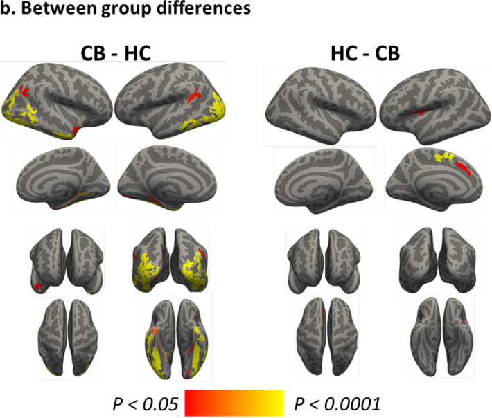 Between group differencesNotes: The results from whole-brain vertex-wise analysis of electric fields between cannabis users (CB group) compared with healthy controls (HC group) for A) CB>HC and B) HC>CB based on a general linear model analysis in Freesurfer. The statistical maps are depicted on the inflated surface to allow visualization of sulci (dark gray) and gyri (light gray). The regions that remained significant following a cluster-based multiple comparison correction procedure are depicted (cluster-wise threshold, P<0.05).